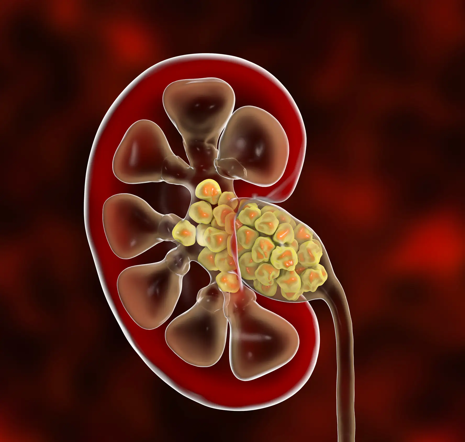Kidney stones are the worst natural pain a human can experience (Getty stock)