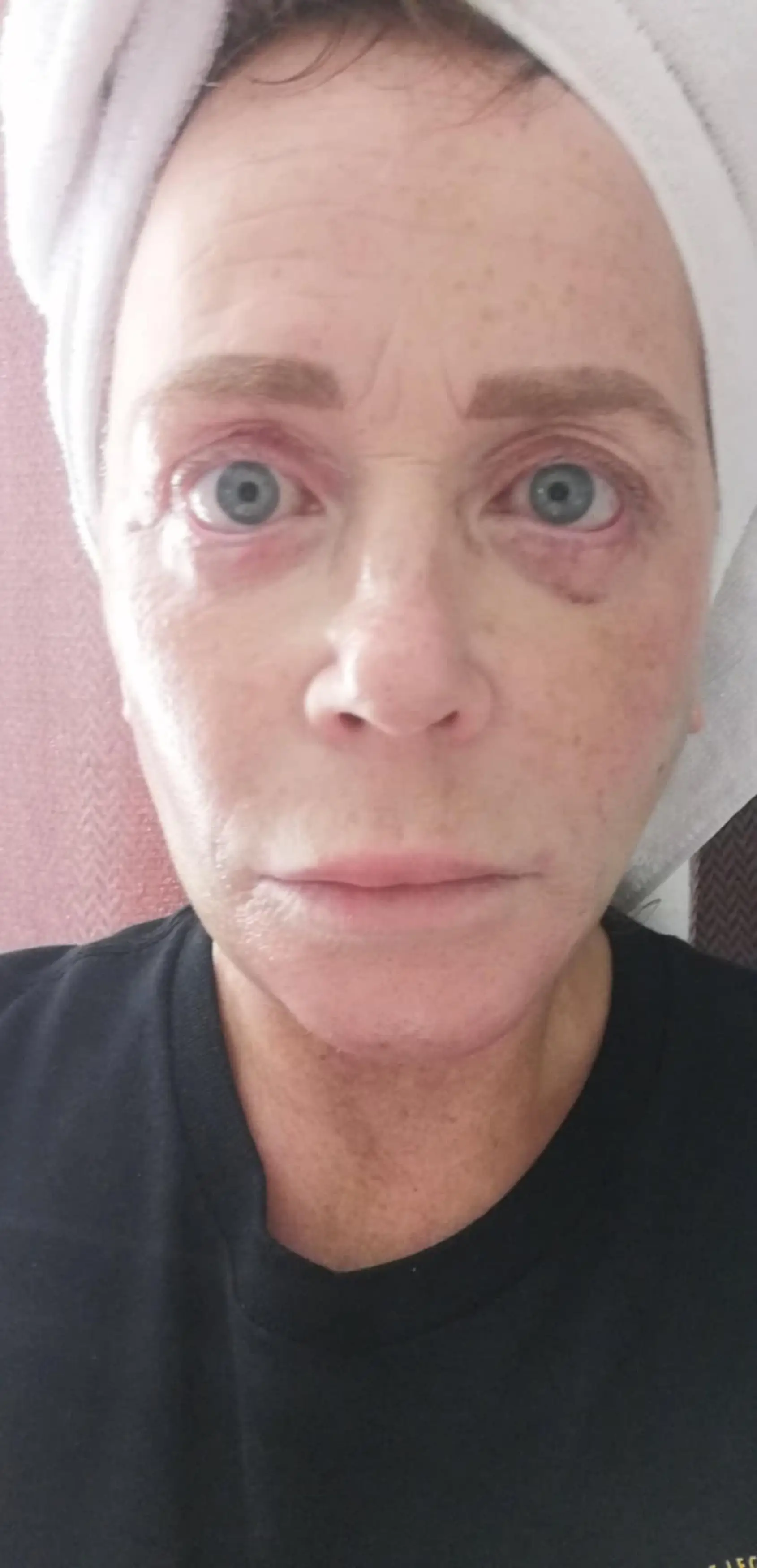 Law has labeled the hospital a 'butcher's shop' after surgery left her unable to close her eyes (Kennedy)