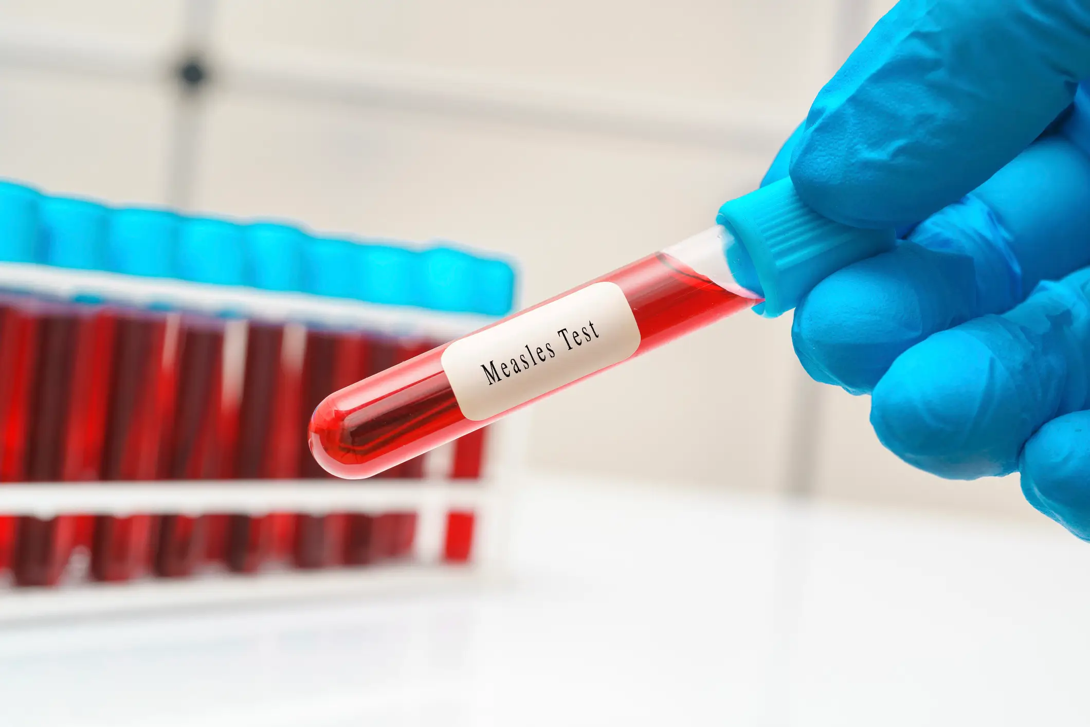 the US has seen a spike in measles cases (Getty Stock Images)