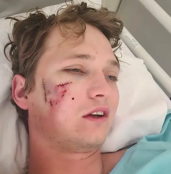 Hohls was attacked by two hyenas (Nicolas Hohls)