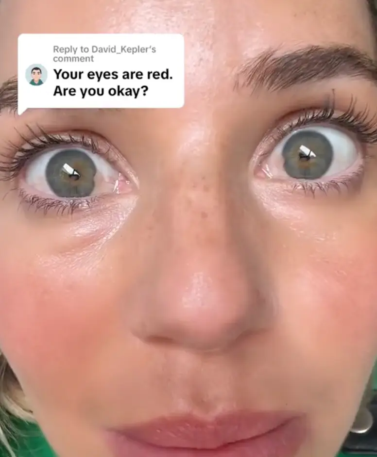 Laura was diagnosed with pterygiums on her eyes (TikTok/ @laurac1are)