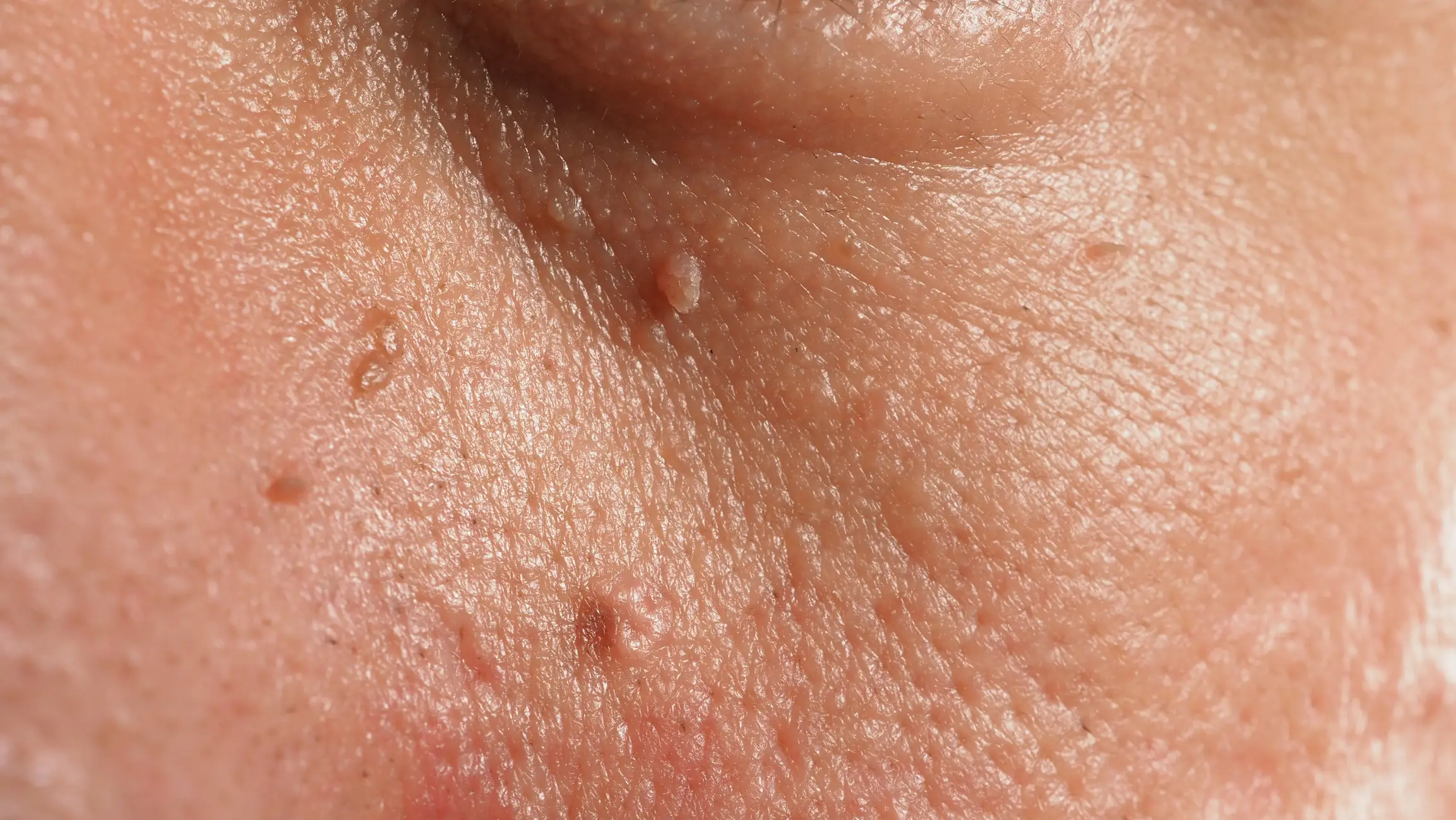 Dermatologist Dr Danny Guo broke down some of the most common skin bumps, including sebaceous hyperplasia, on his YouTube channel. (Getty stock image)