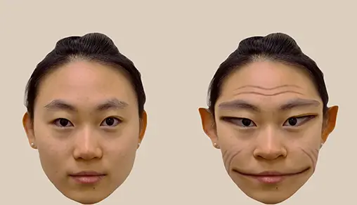 The condition is called prosopometamorphopsia (Antonio Mello/The Lancet)