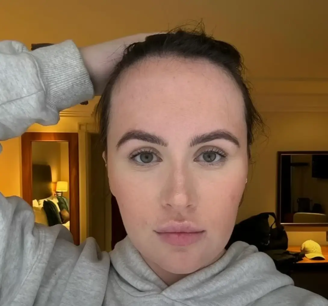 Beth Halsey has always been self conscious about her forehead. (ITV)