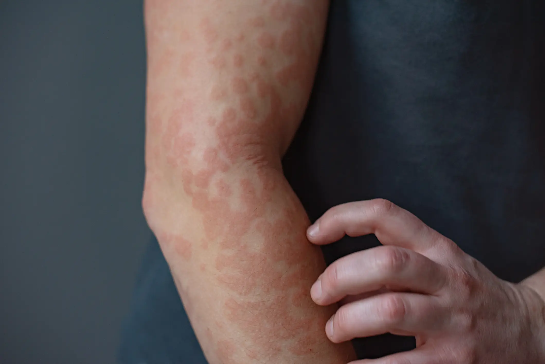 Daisy suffered intense itchy hives like this (Getty Stock Image)