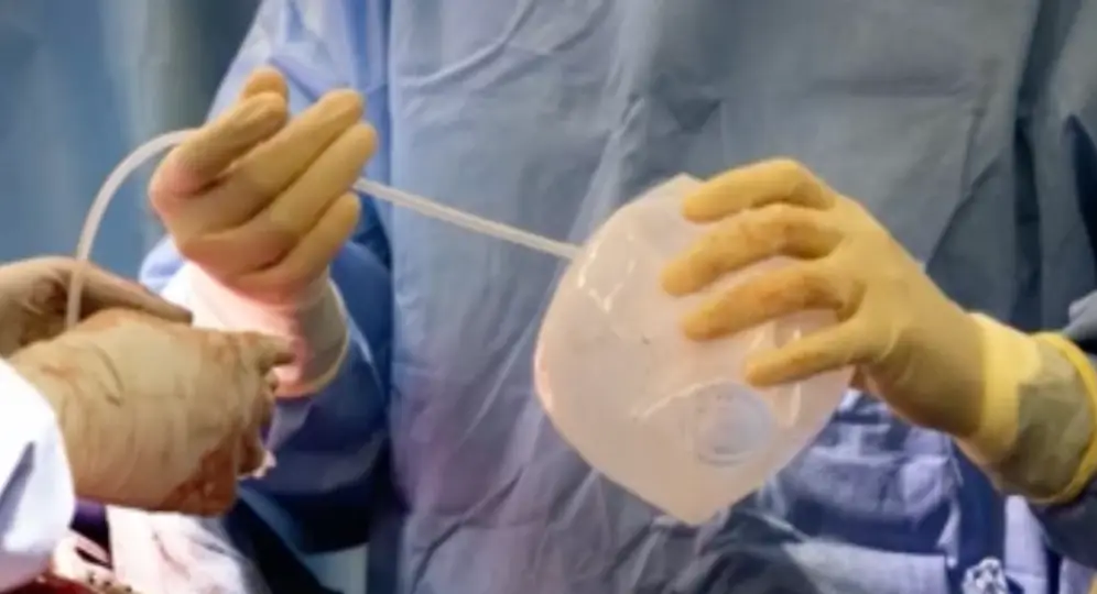 The implants helped support Bauer's heart.