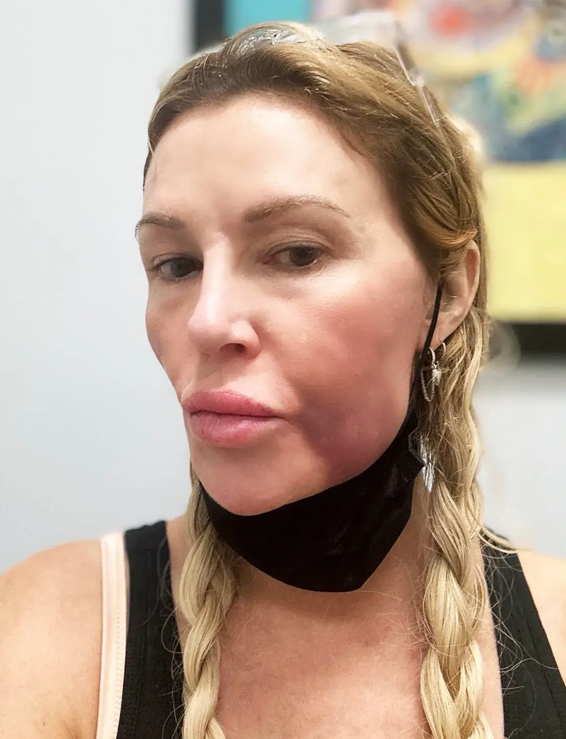 The star previously shared pics of her facial disfigurement (X/Brandi Glanville)