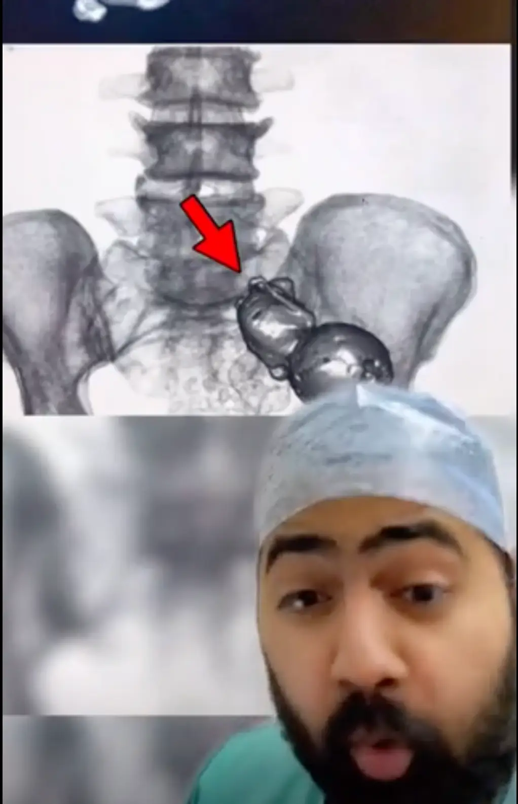 Ectopic pregnancies usually happen when the fertilised egg attaches itself to the inside of the fallopian tube.