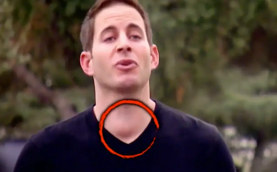 The lump on Tarek El Moussa's neck (Inside Edition)