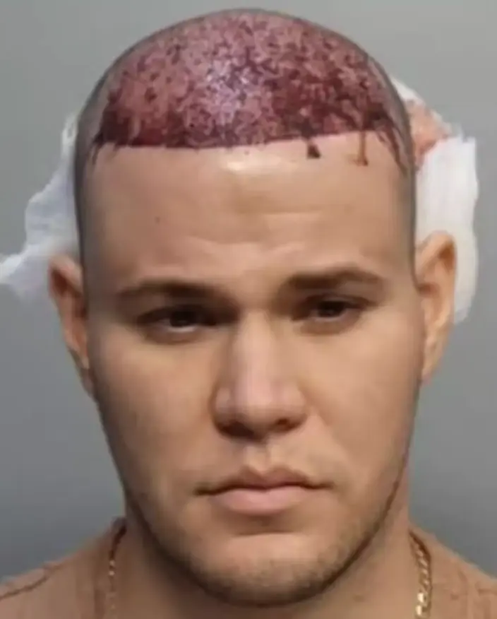 The hair transplant didn't go well. ( Miami-Dade Corrections & Rehabilitation)