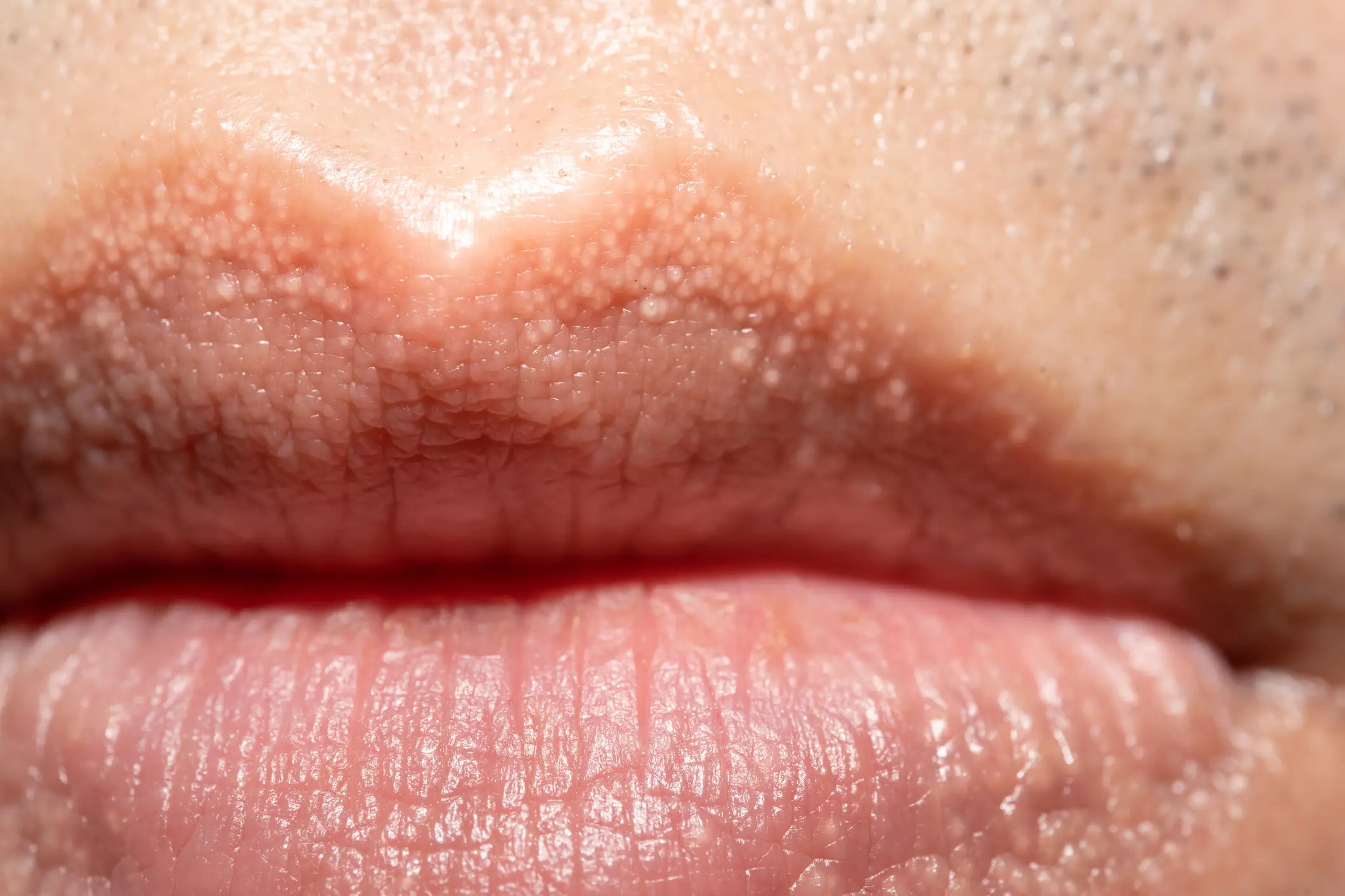 Fordyce spots are not an STI, STD or cancerous (Getty Stock Images)