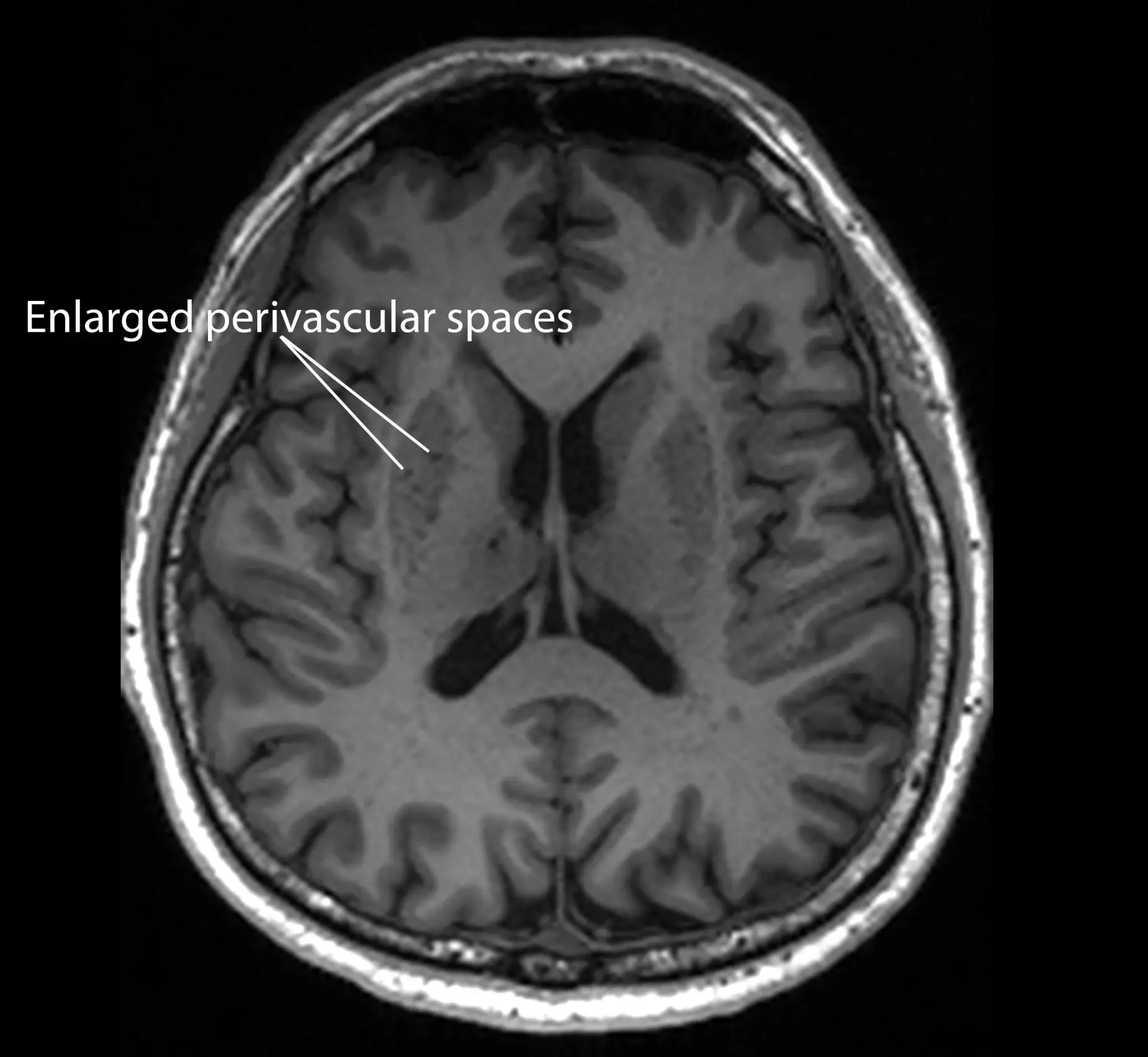 A patient who with enlarged perivascular spaces, as seen on an MRI scan (NTU LKCMedicine)