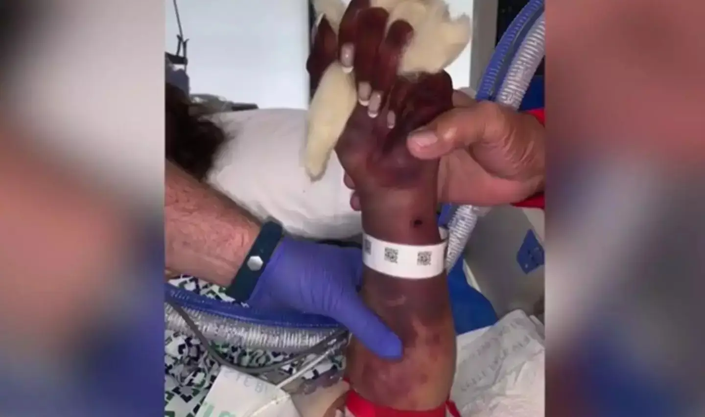 Marie contracted a rare infection from bacteria called capnocytophaga canimorsus (Marie Trainer)