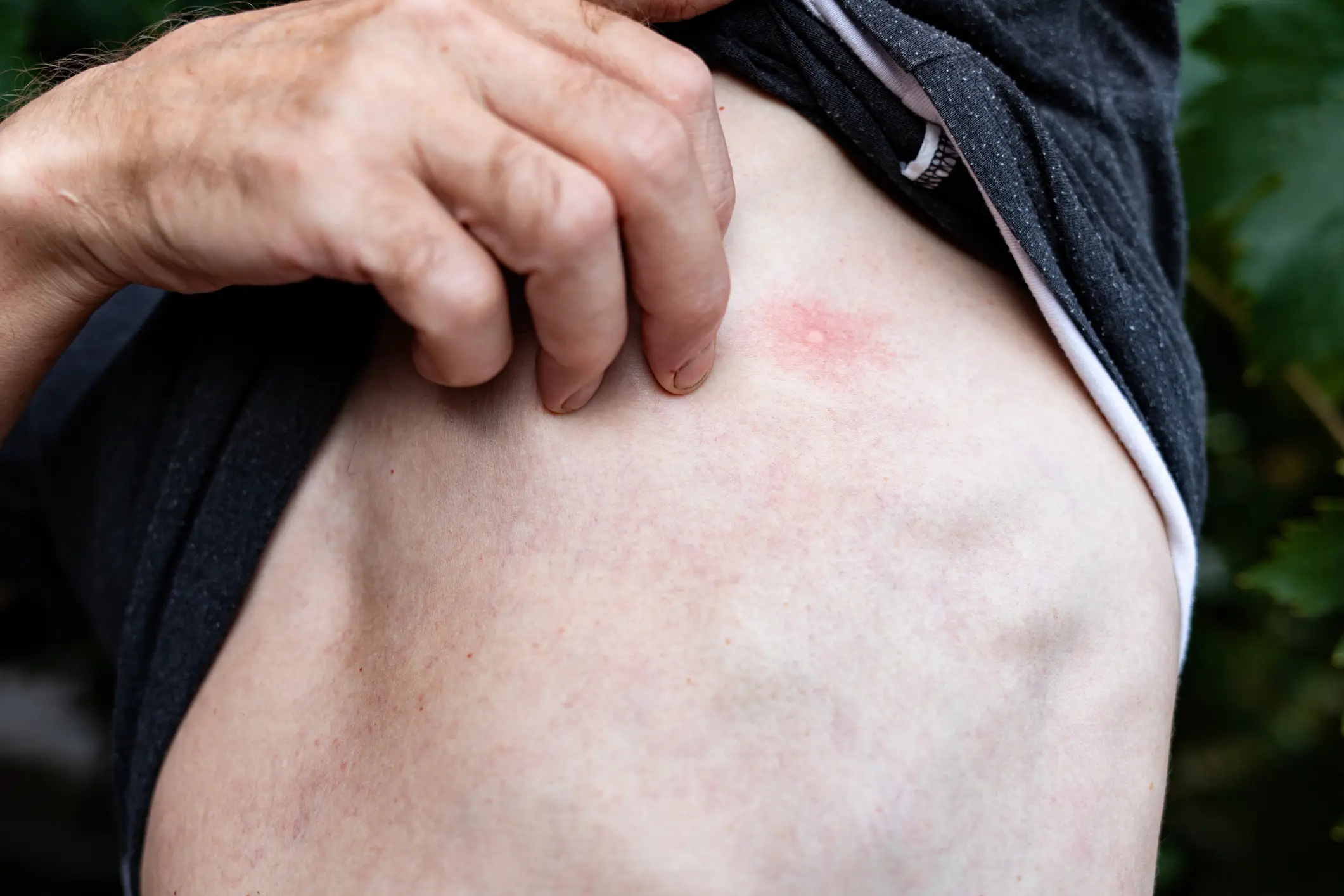 The dad noticed a bug bite before his health took a turn (Getty Stock Images)