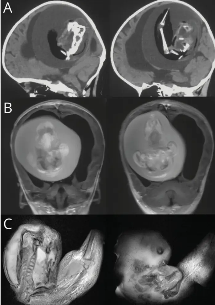 The head CT scan of the one-year-old (Neurology Journals/ Zongze Li et al)
