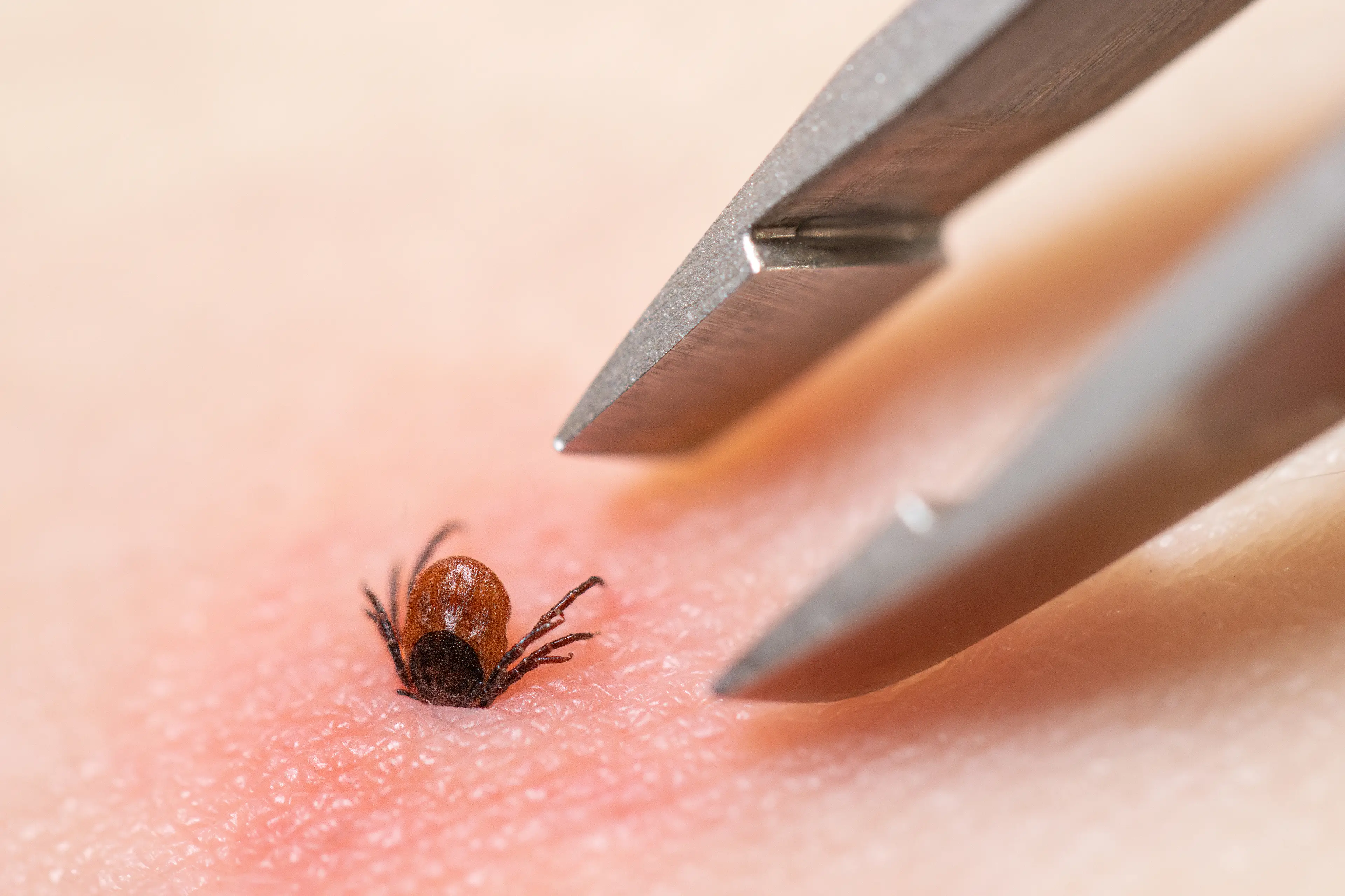There are many symptoms of Lyme disease to be aware of (Getty Stock Photo)