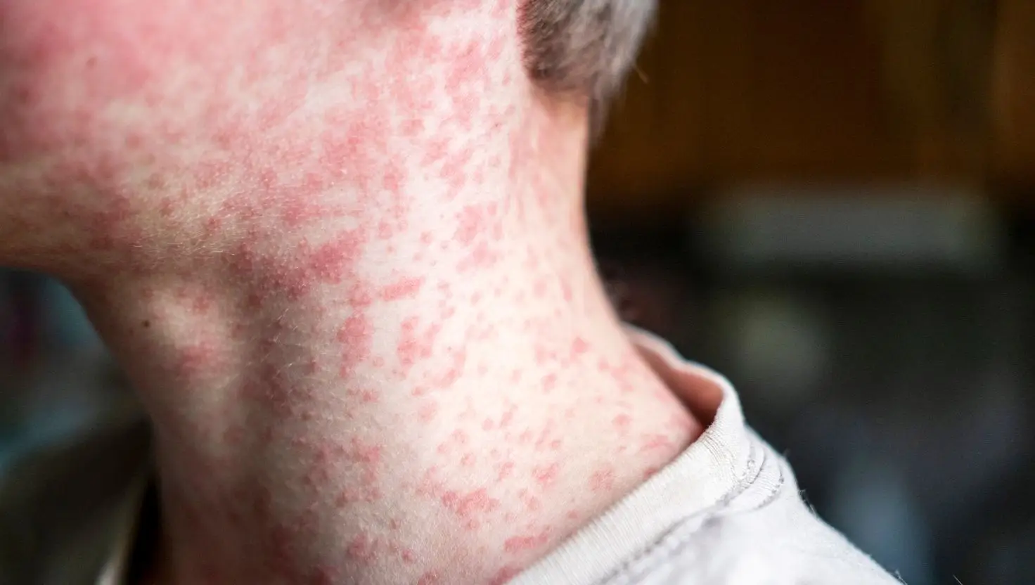 Experts have issued fresh information on the Utah measles outbreak (Getty Stock Image)
