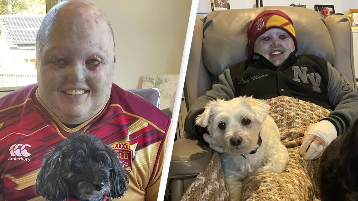 Man lives with 'worst disease you've never heard of' that makes skin 'fragile as tissue'