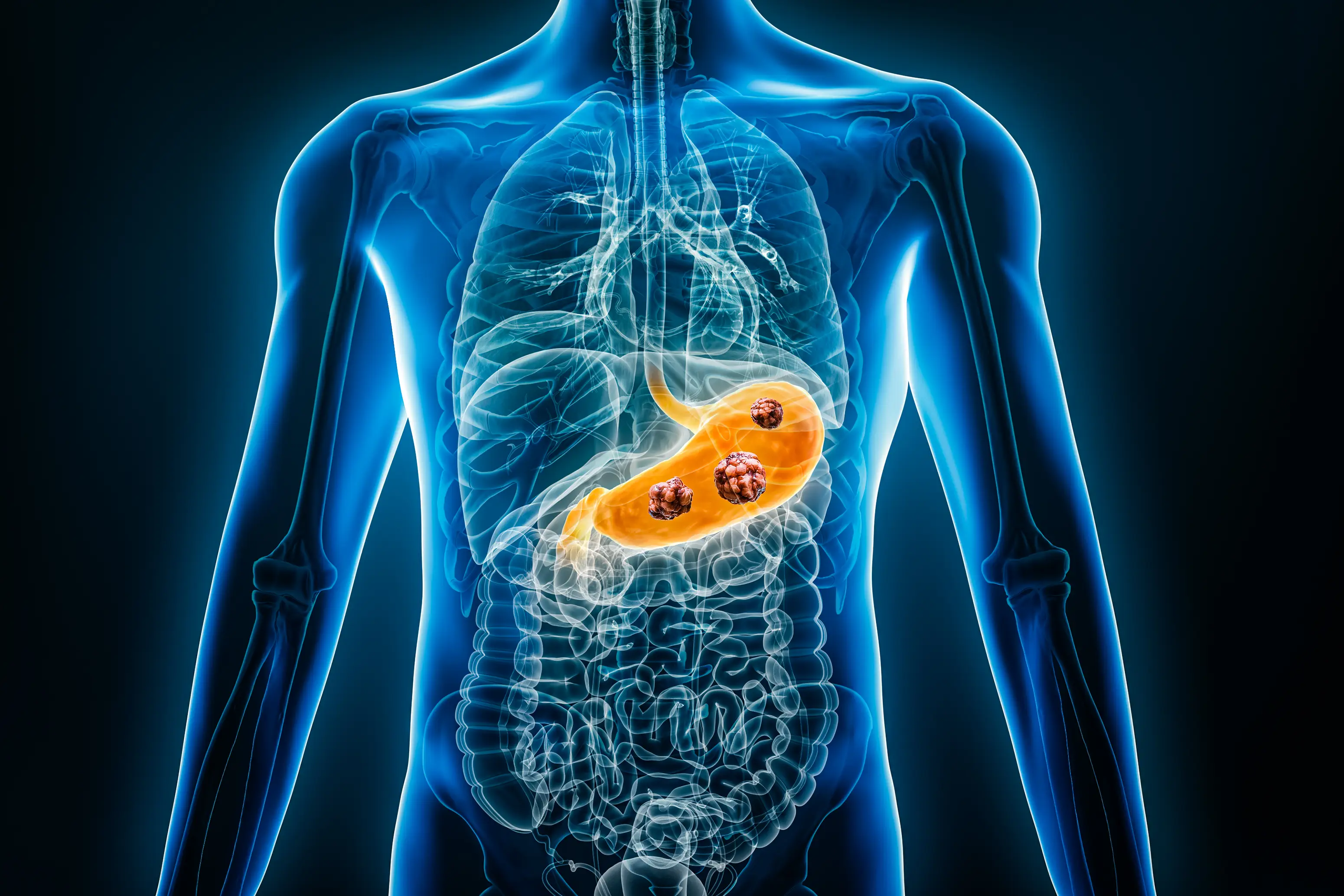 Not every case of stomach cancer presents with symptoms (Libre De Droit/Getty Images)