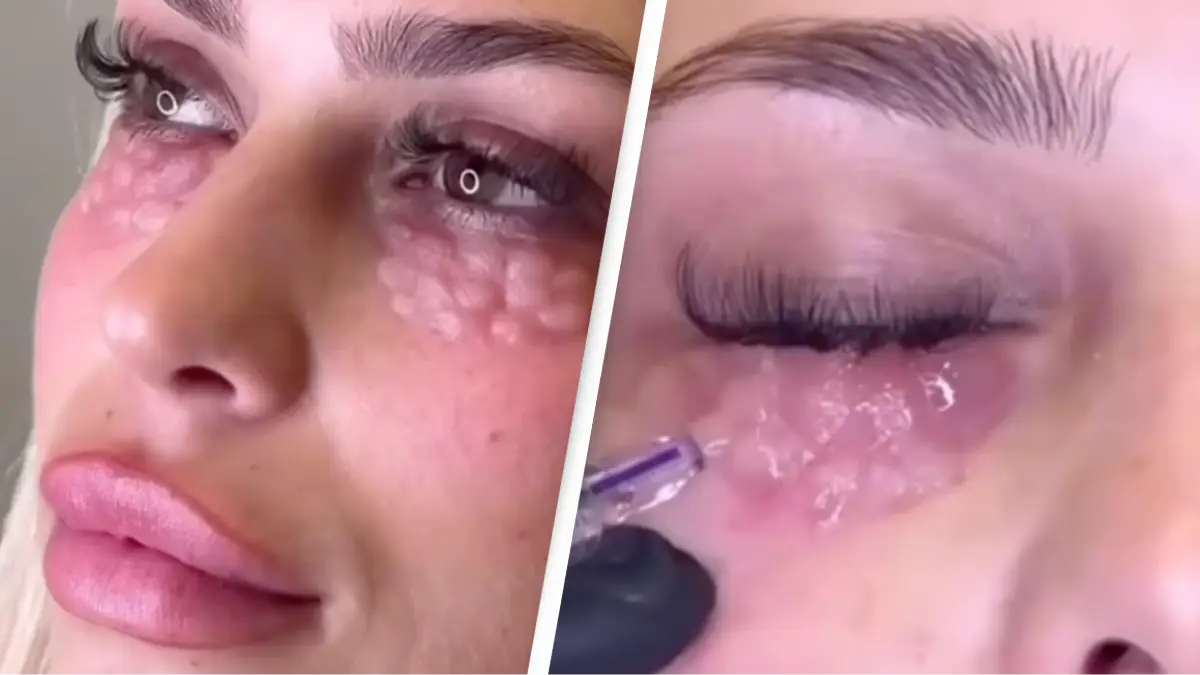 halinacuppingclinic/Instagram