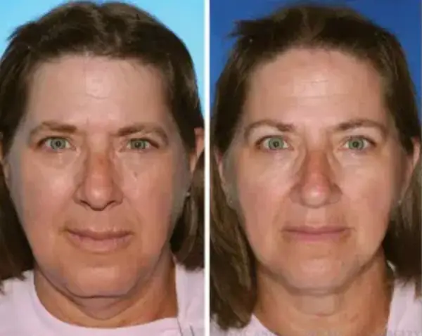 The twin on the left had smoked more than two decades longer than her sister (American Society of Plastic Surgeons)