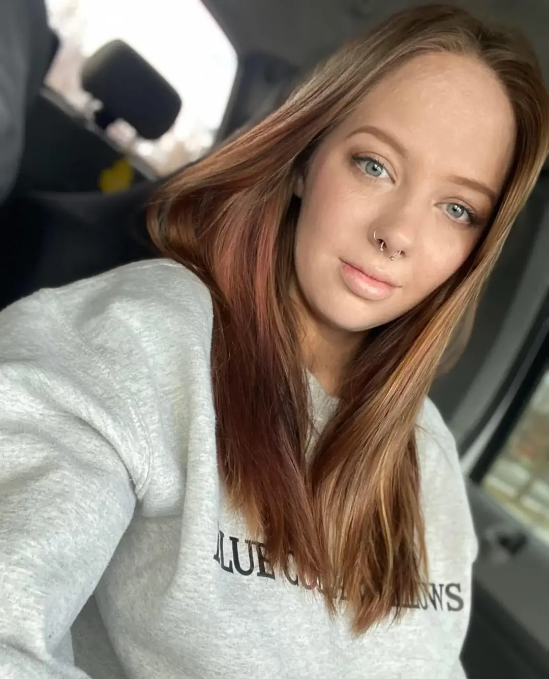 Her burns are hardly visible on her face following successful recell surgery (Reddit/abbeyiskewl2)