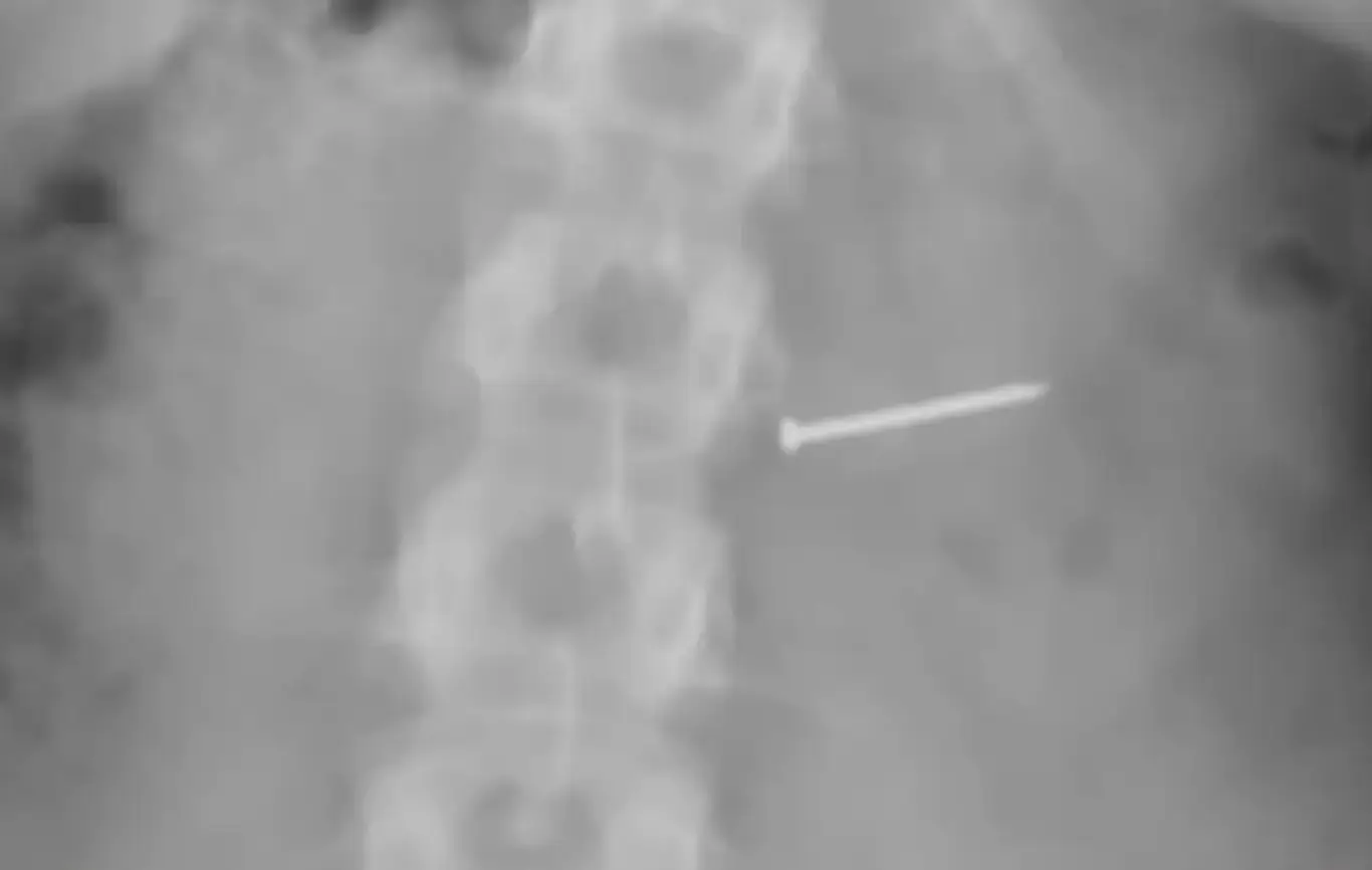 The mom underwent an X-ray which found a nail in her body (WESH-TV)