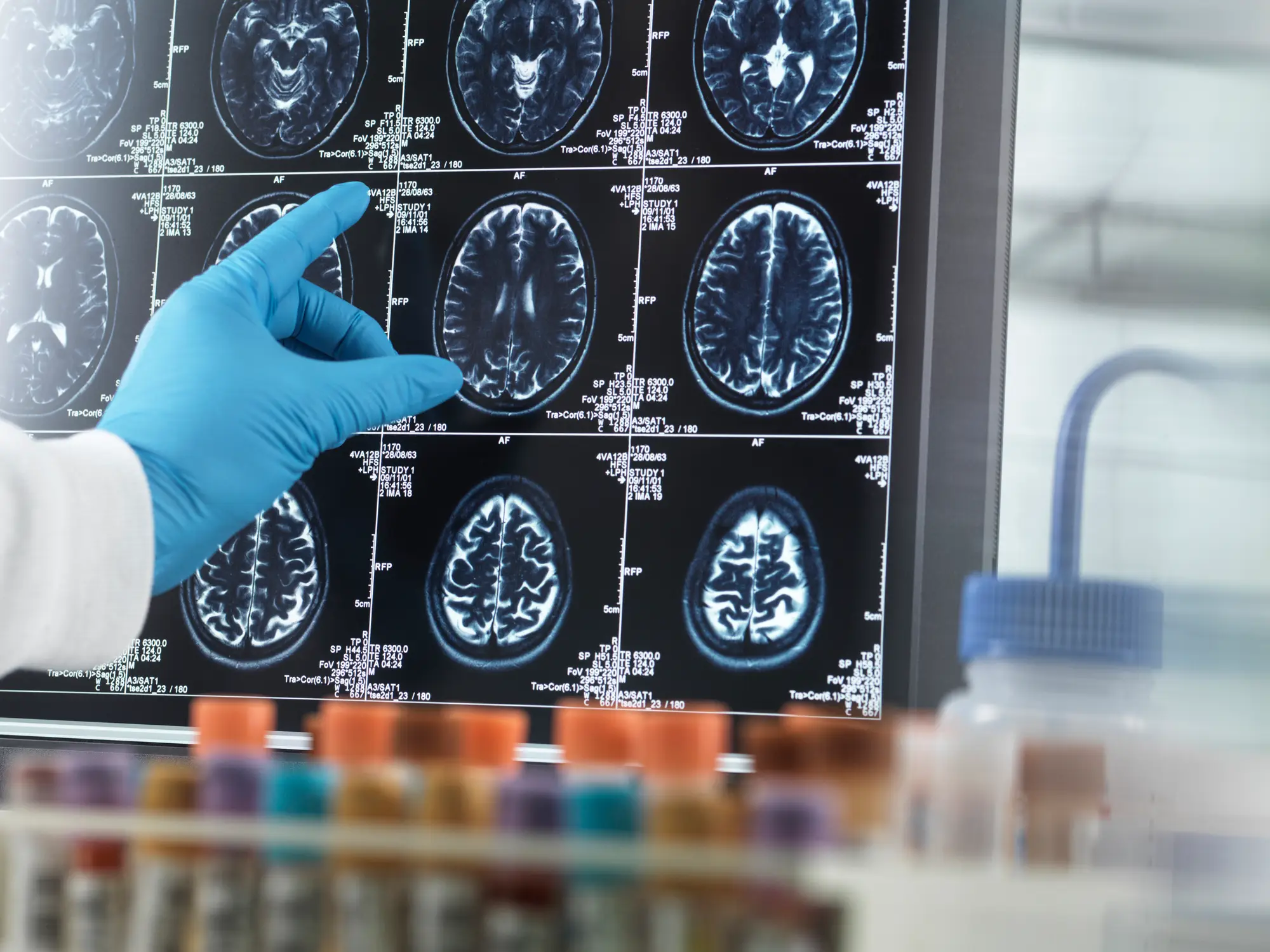 Dementia impacts around six million Americans (Tek Image/Science Photo Library/Getty Images)