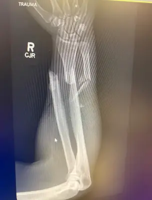 His forearm was crushed (GoFundMe)