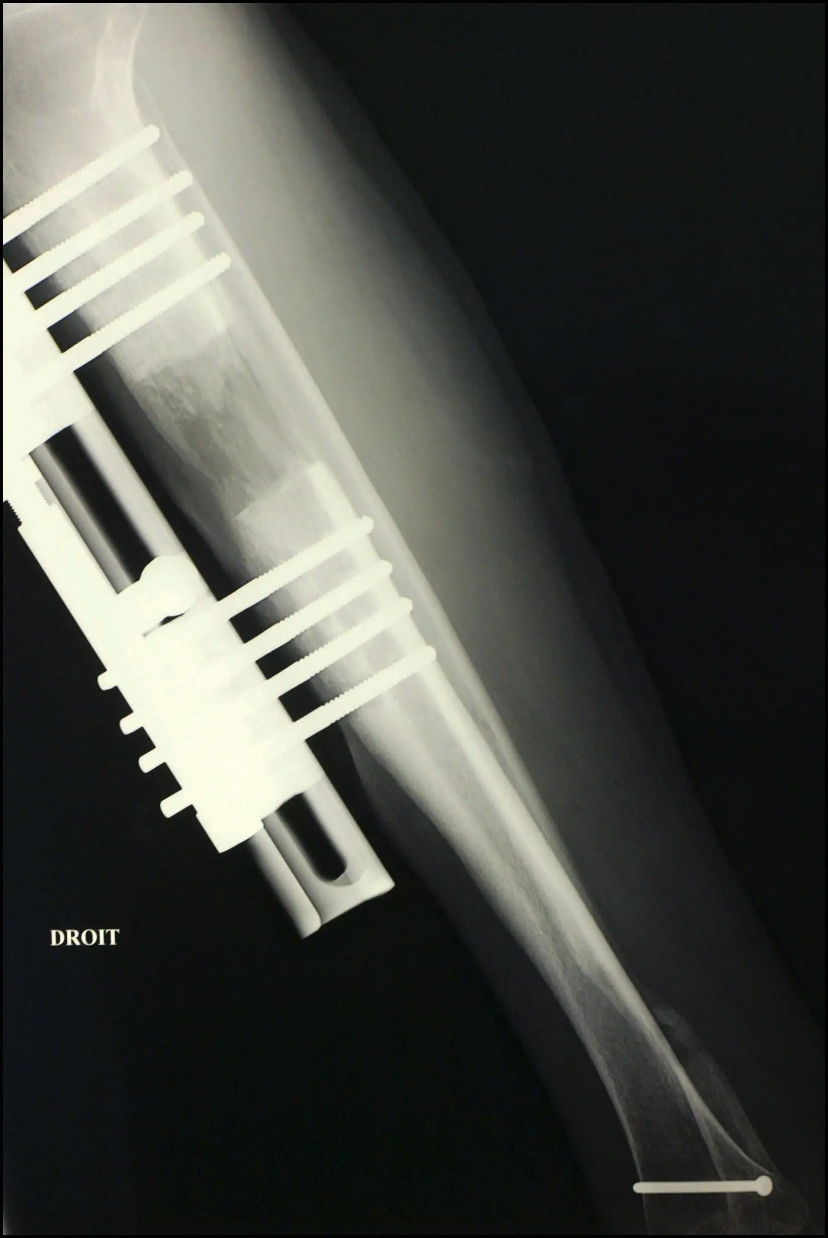 The procedure involves breaking the bones before 'stretching' them as they heal.