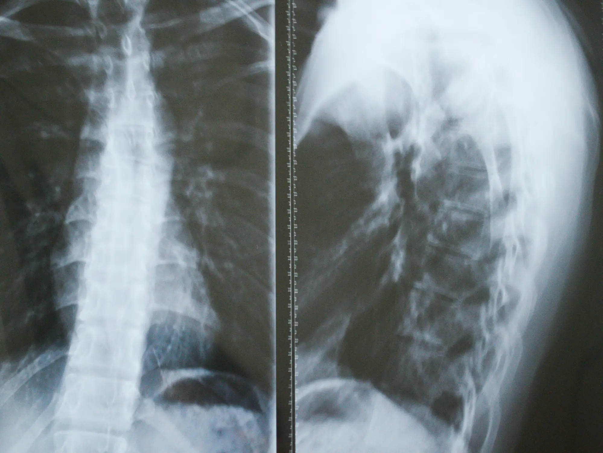 Gorham-Stout Syndrome has left experts baffled (Getty Stock Image)