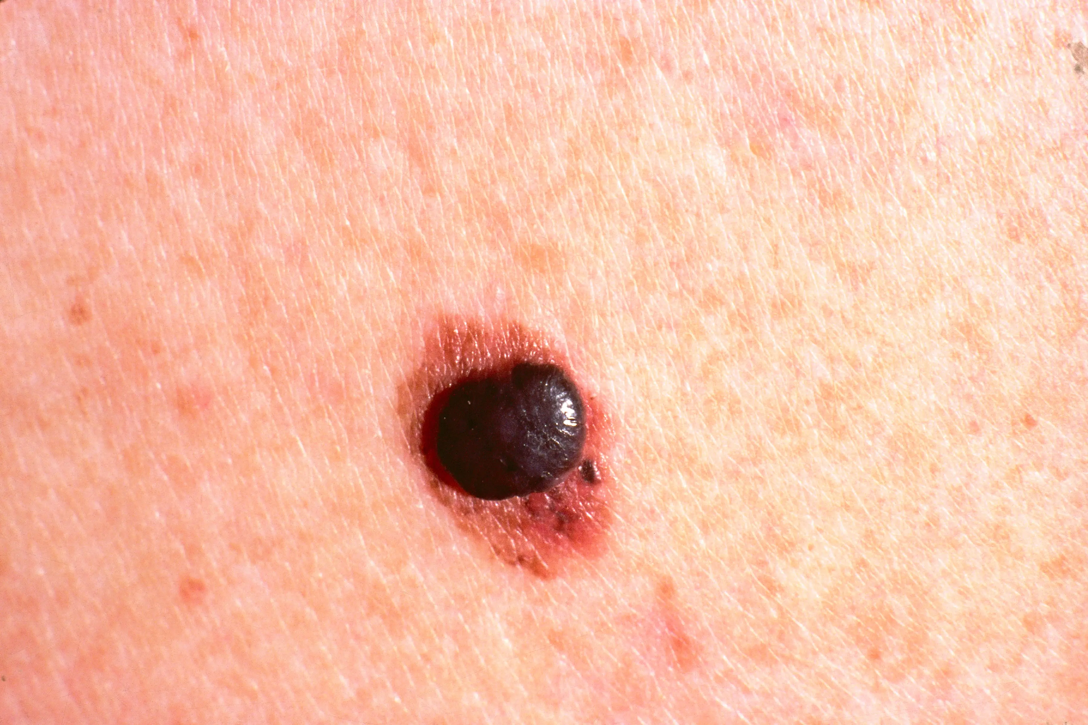 Redness around a mole can be a major cancer warning sign (BSIP/UIG Via Getty Images)