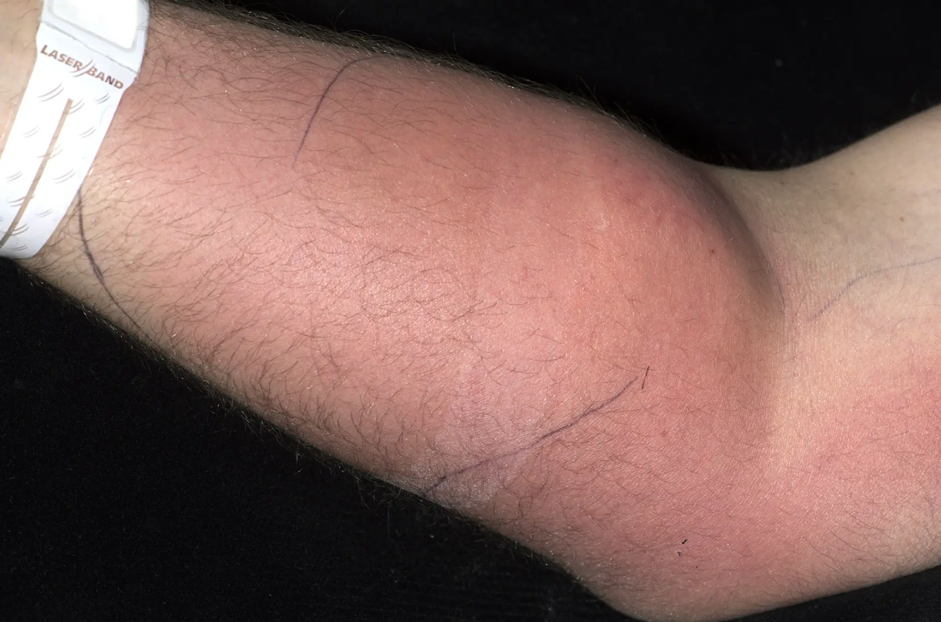 Medics noticed the man's red and swollen arm (Irish Medical Journal)