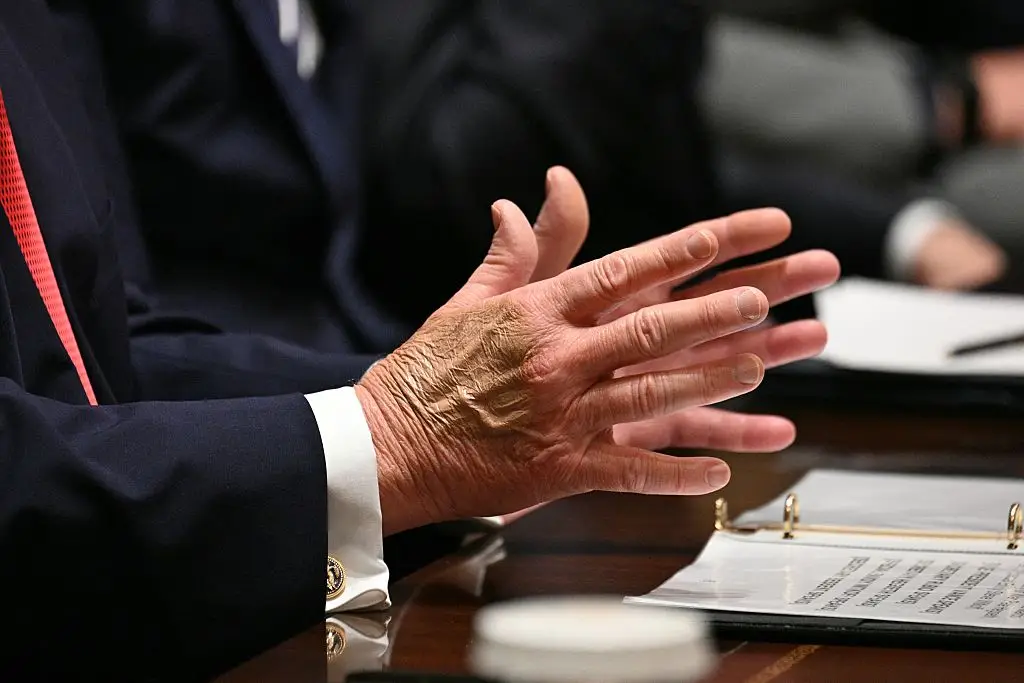 Trump's medical report explained the reasoning for the bruises on his hands (Photo by Jim WATSON / AFP via Getty Images)