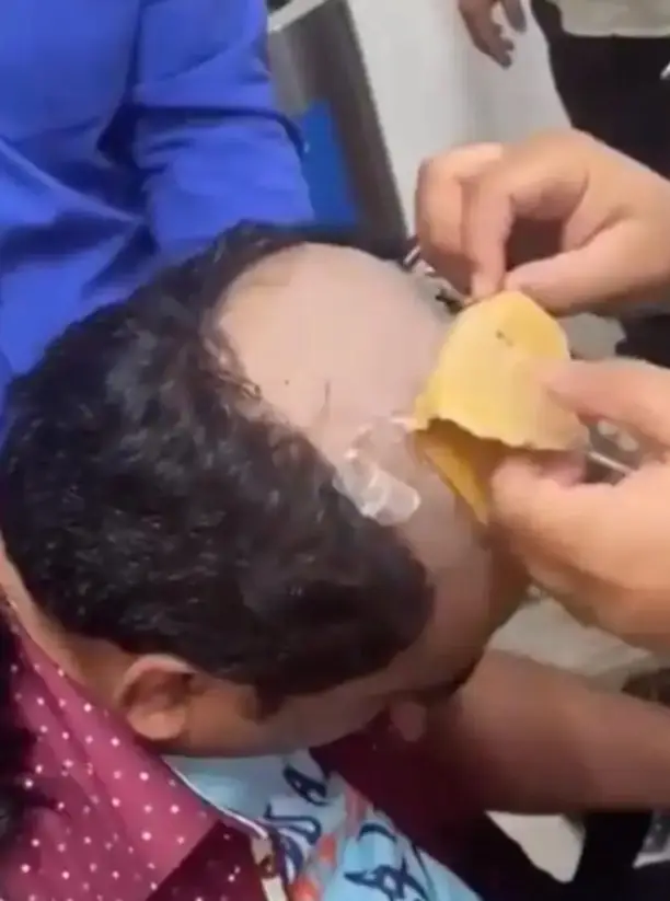 The man got caught smuggling melted gold under his toupee.