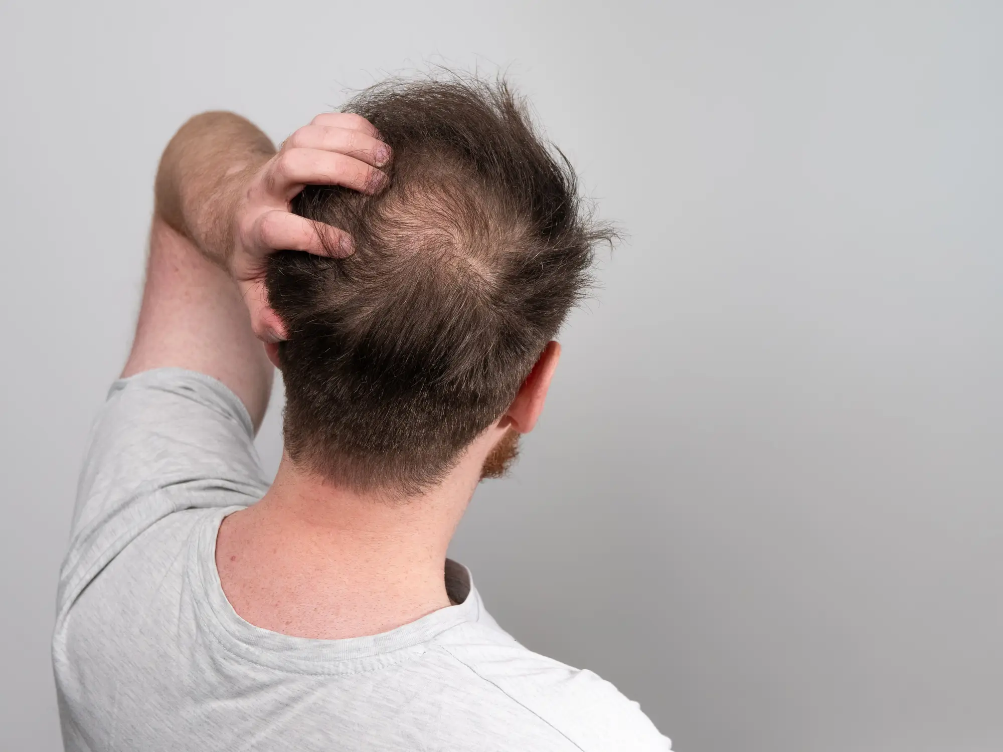Finasteride can be used to treat male pattern baldness (Getty Stock Photo)