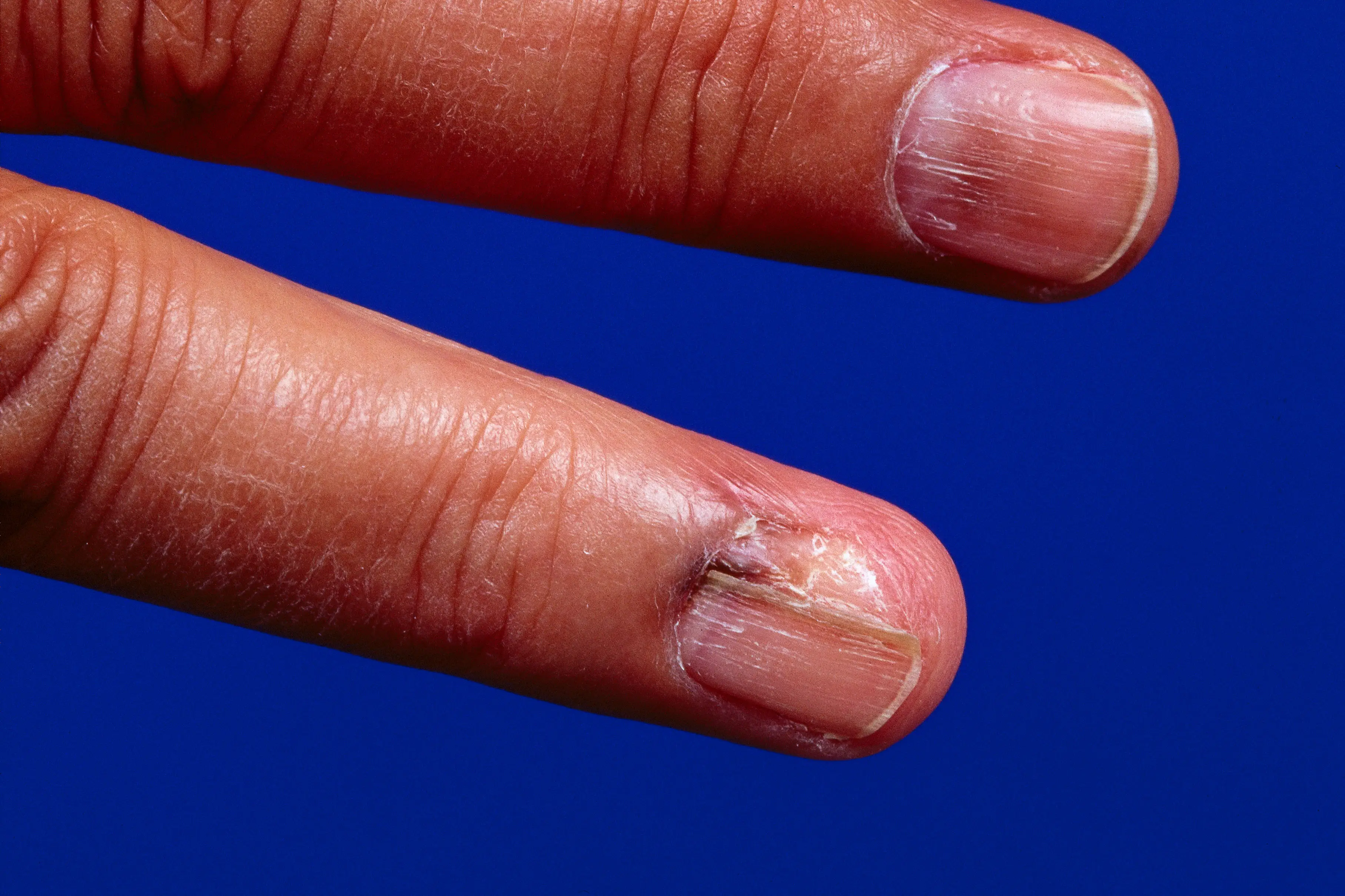 A person's whose nails show malignant melanoma (BSIP/UIG Via Getty Images)
