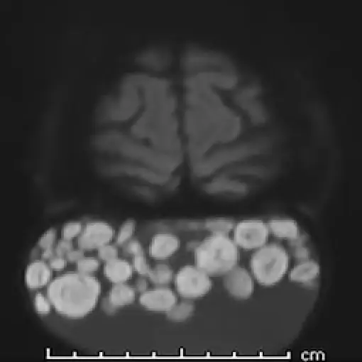 It took half a century before the woman got her growth on the side of her head checked out (Radiology Journal)