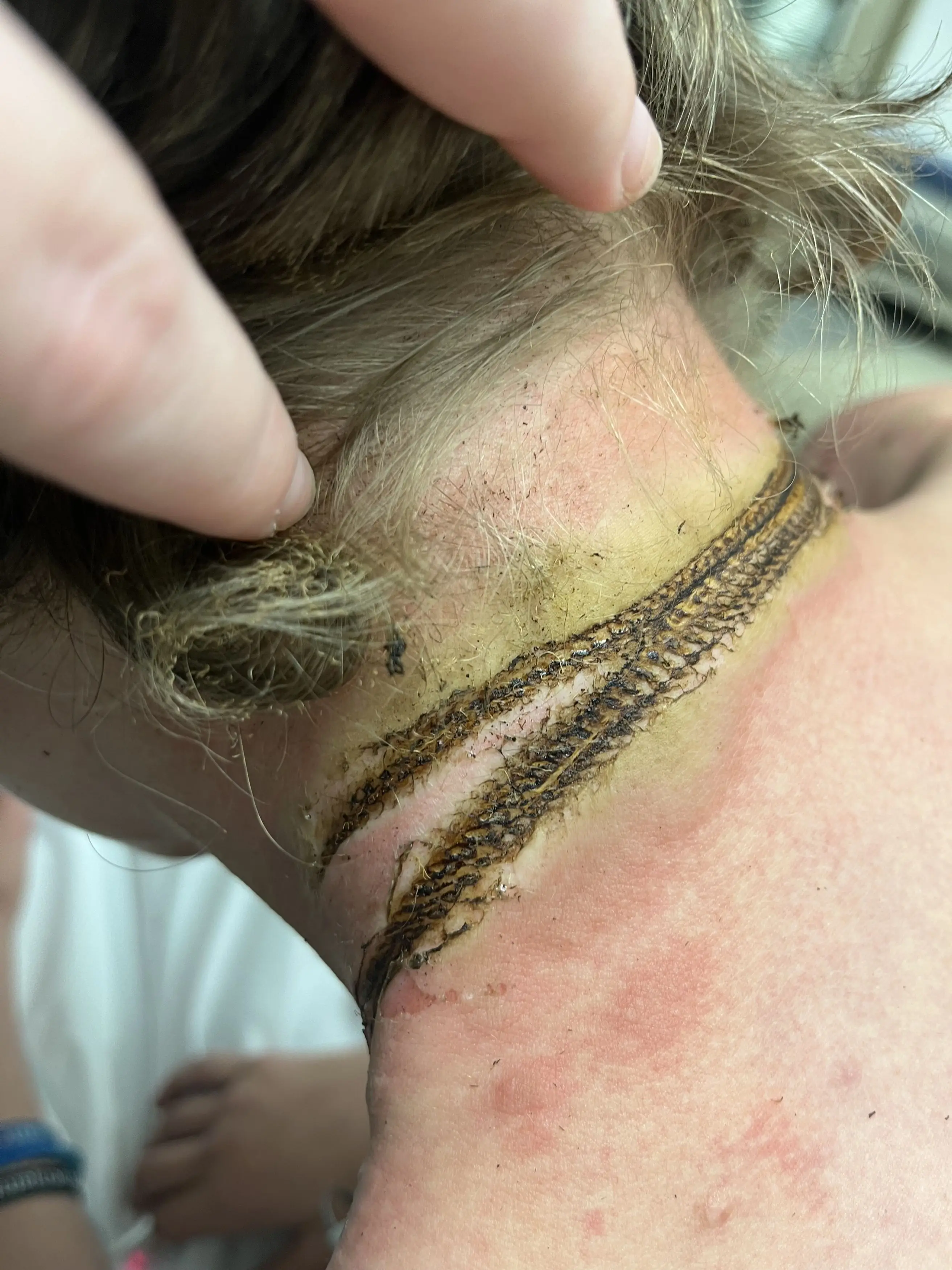 Rayce erlitt schwere Verbrennungen (Kennedy).