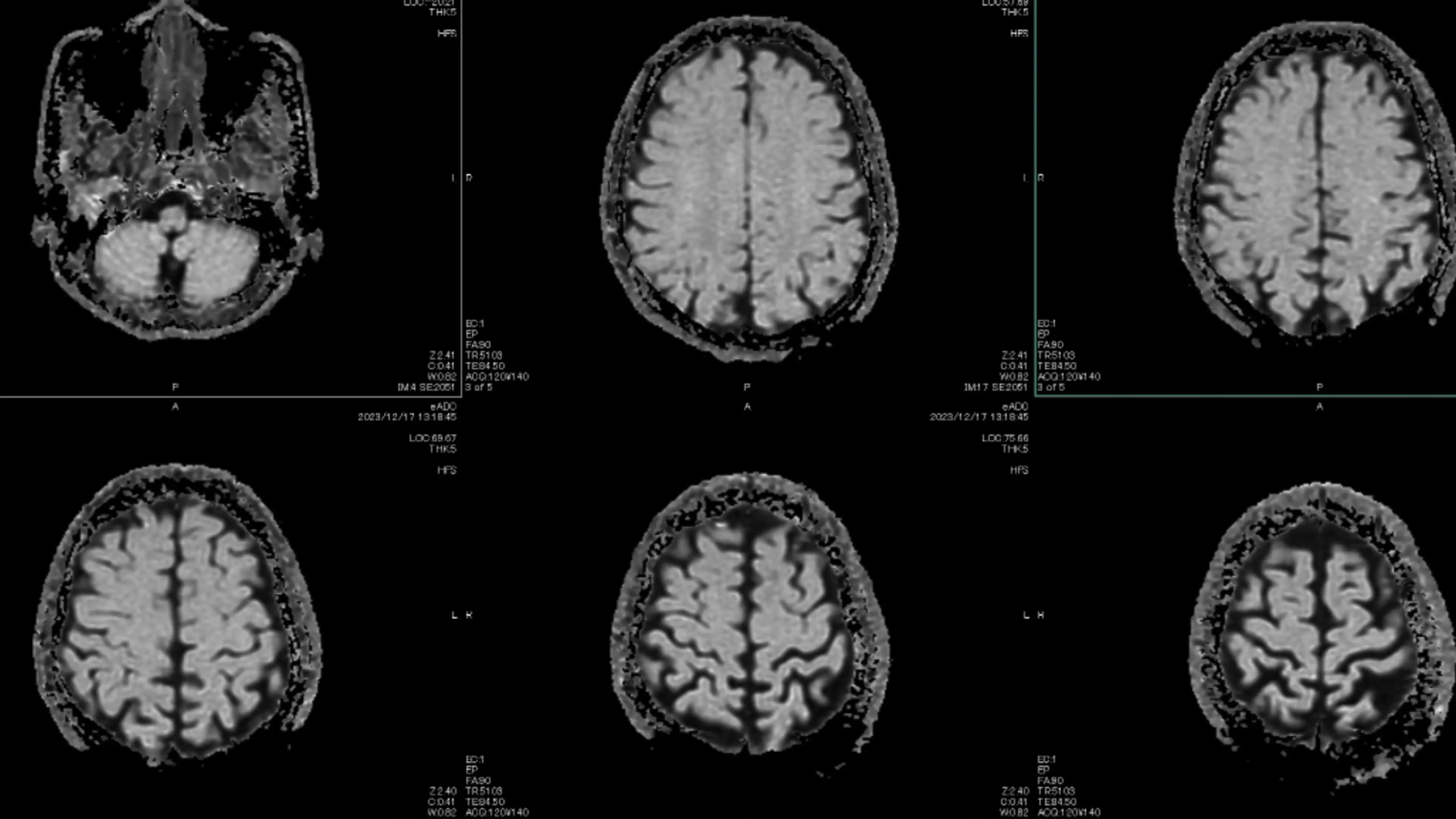 Five nurses were diagnosed with benign tumors (Getty Stock Images)