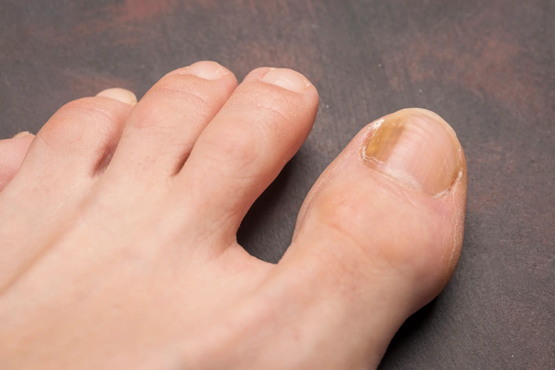 Dark streaks in the nail can be a sign of the melanoma (Getty Stock Photo)