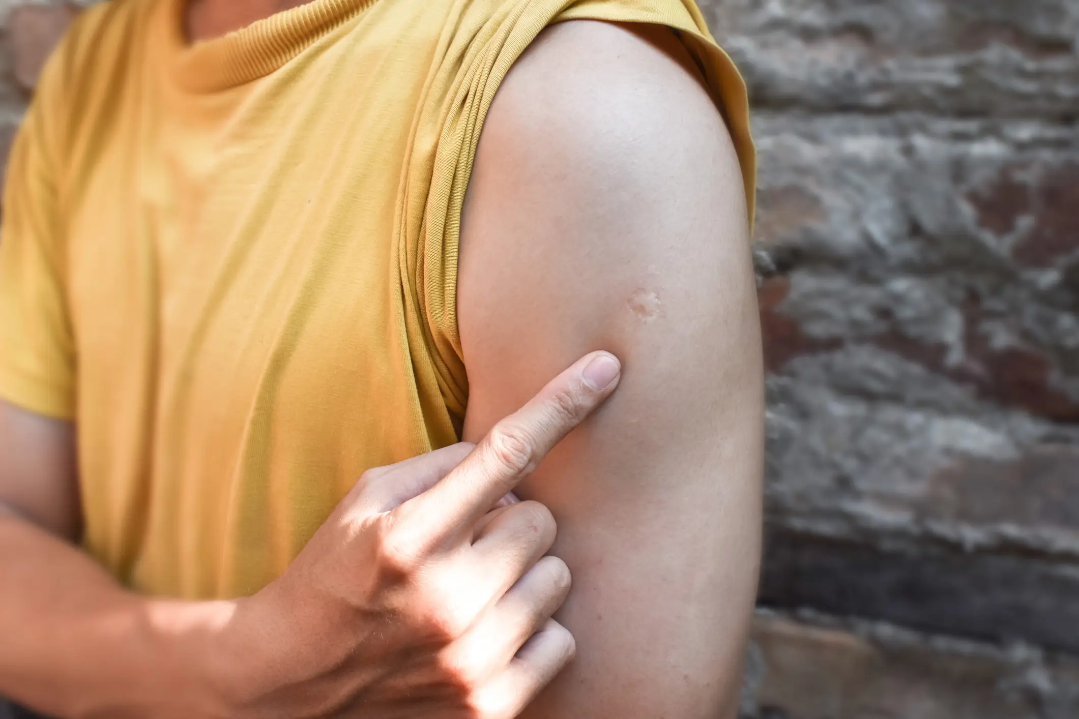 Lots of people may find that they have a BCG vaccination scar (Getty Stock)