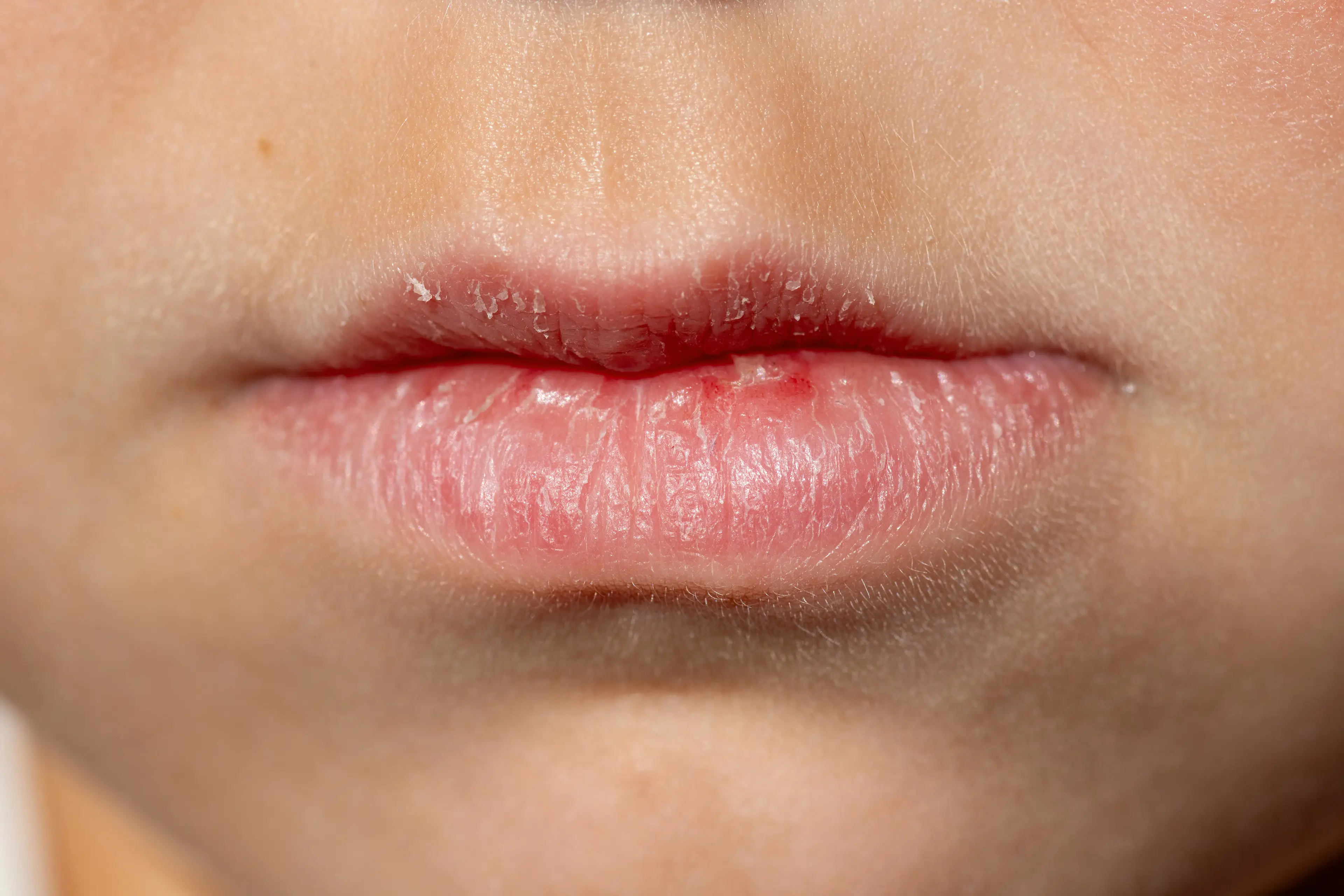Chapped lips can be irritating and uncomfortable (Tatiana Cheremukhina/Getty)