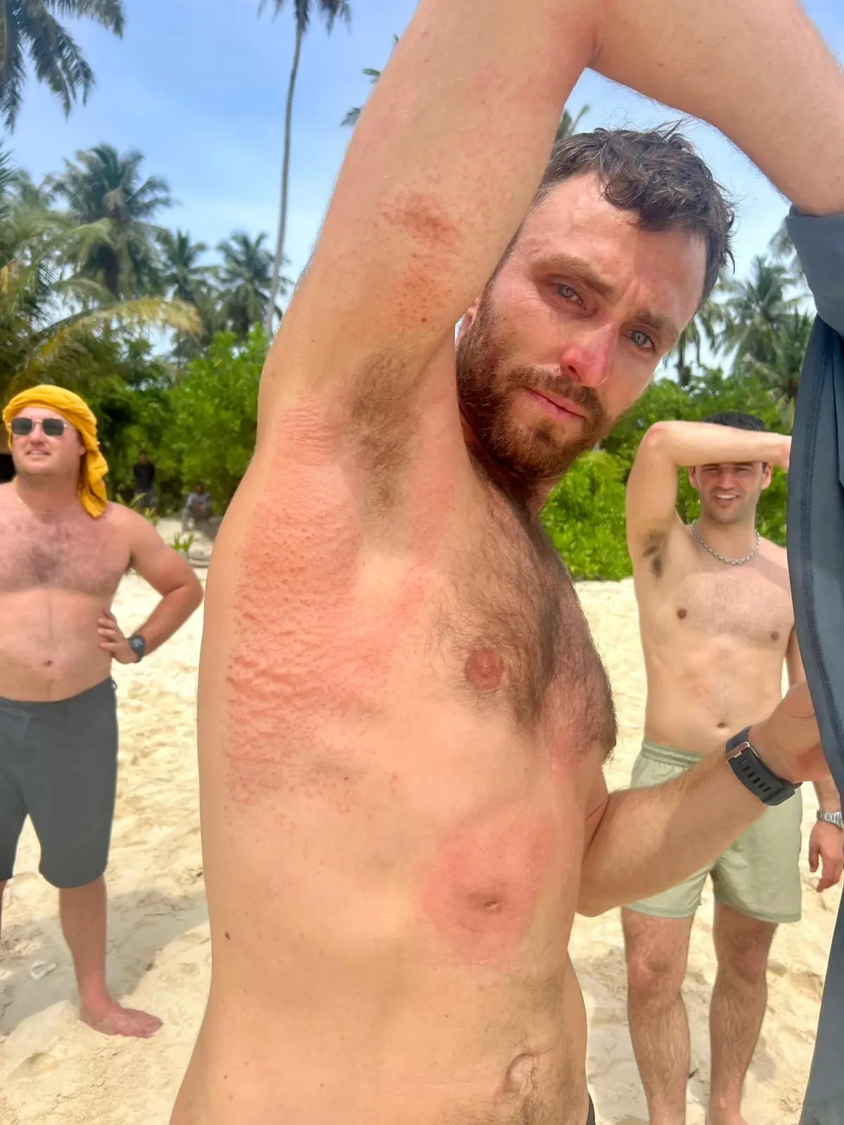 Elliot Foote pictured on the same day of his rescue with rashes all down his side (Courtesy of Elliot Foote)