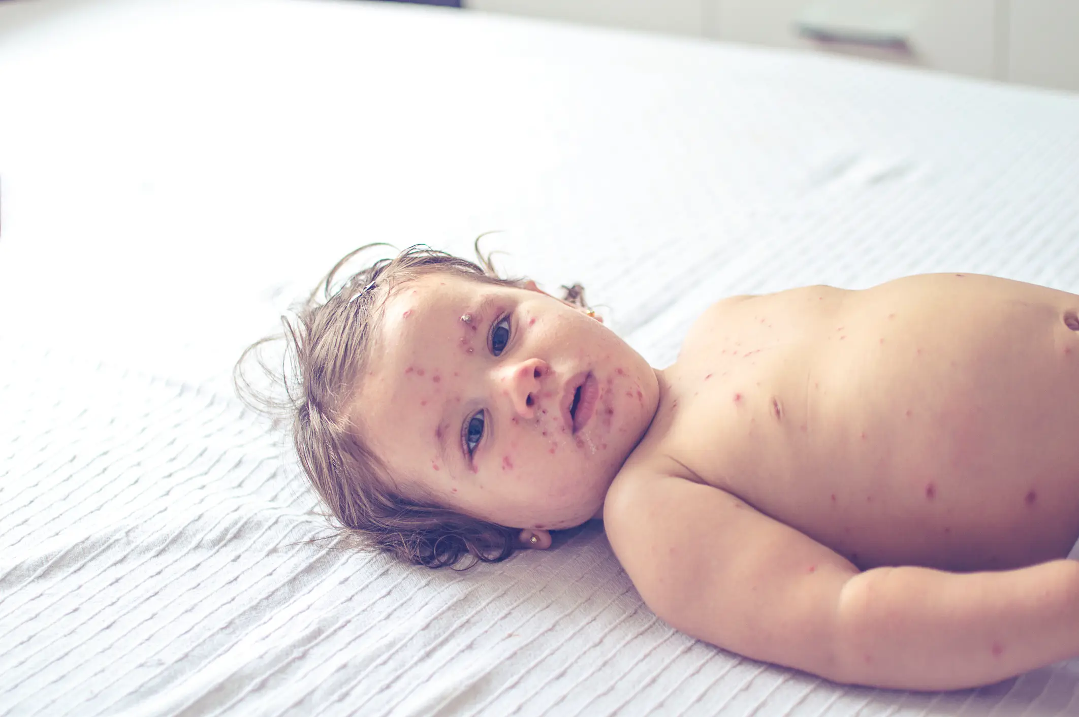 Children under the age of five have been worst impacted by the measles outbreaks (GdinMika/Getty Images)