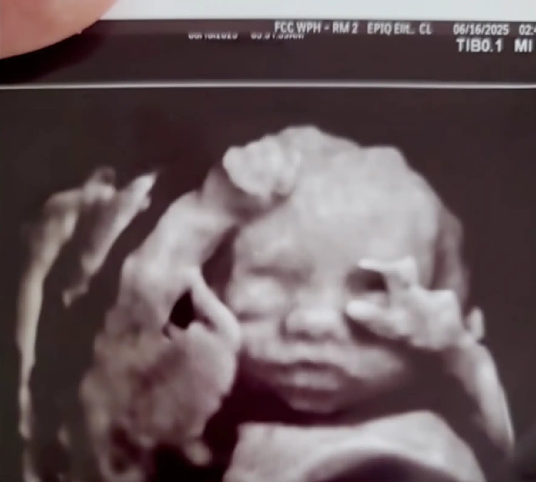 Baby Cassian had developed a rare and often fatal condition in the womb (ABC/YouTube)