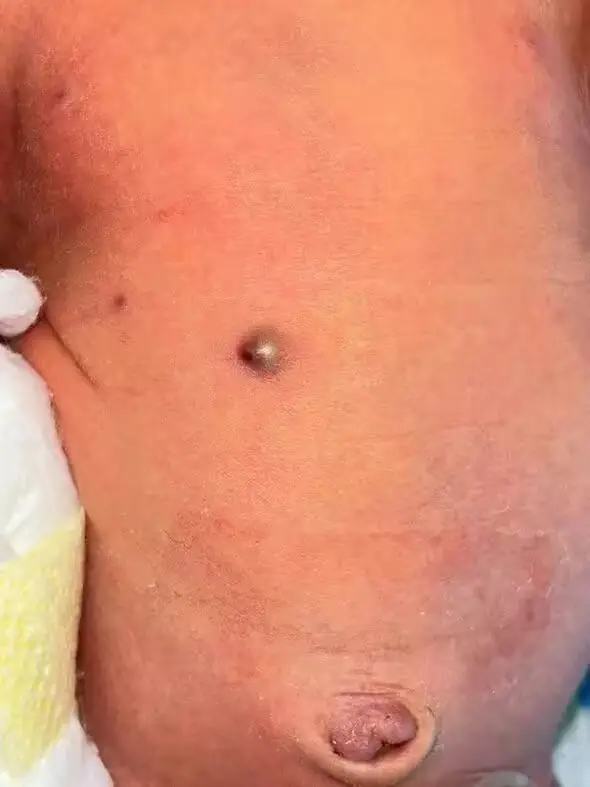 Doctors removed the pellet from the infant's stomach. (Newsflash)