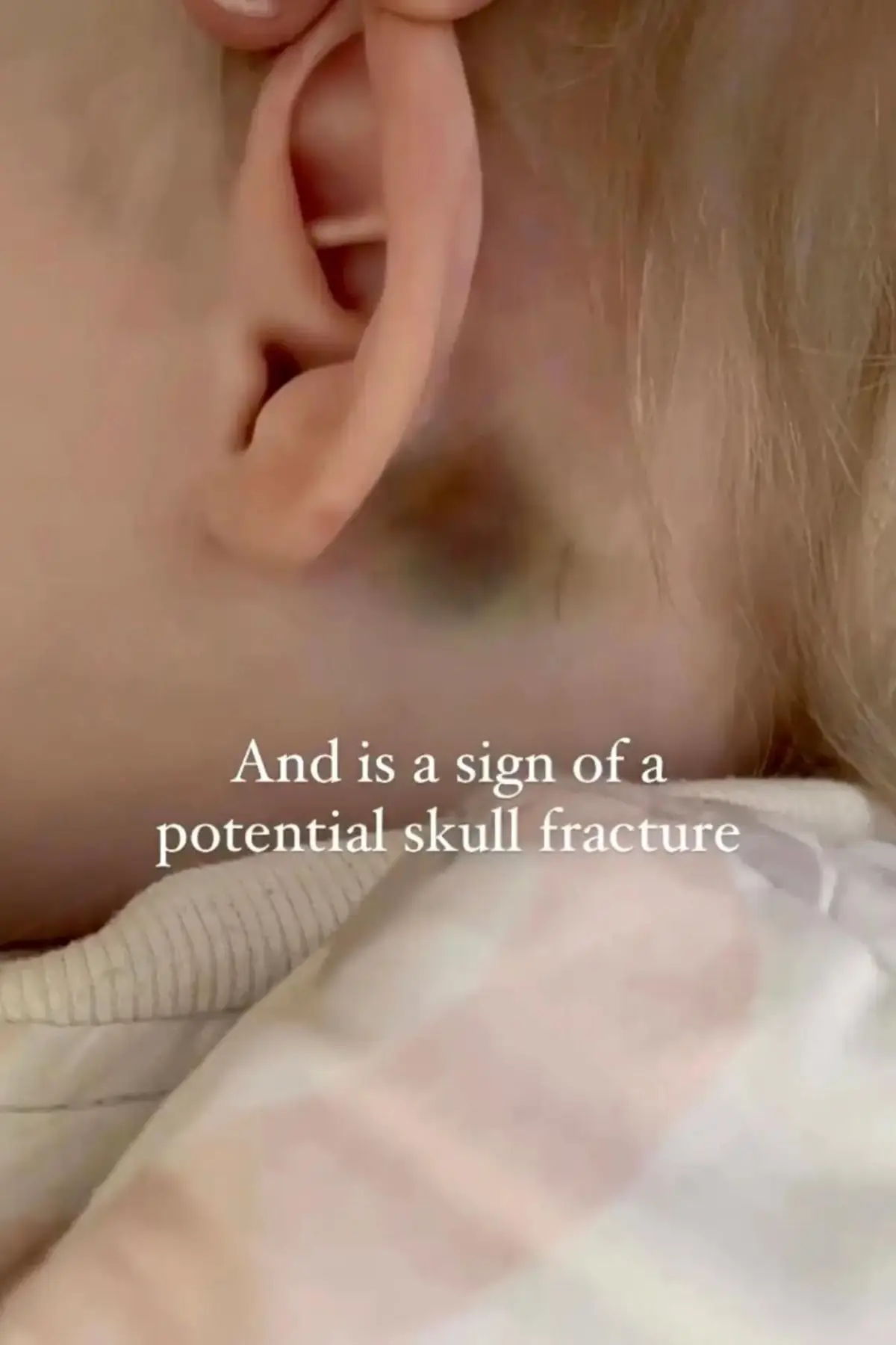 Parents are being advised to look out for bruises on their child's head. (Instagram/@tinyheartseducation)