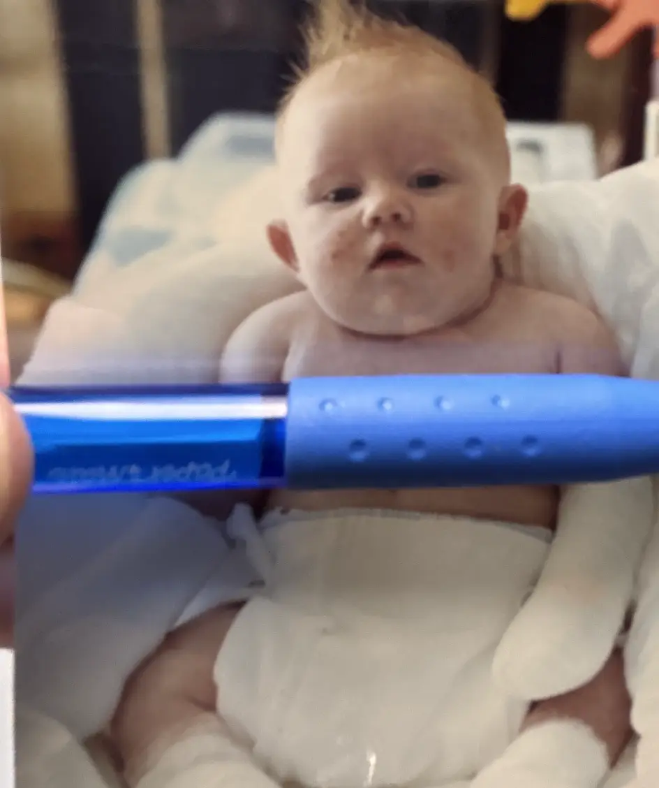 She was diagnosed with the extremely rare condition as a baby (Supplied)