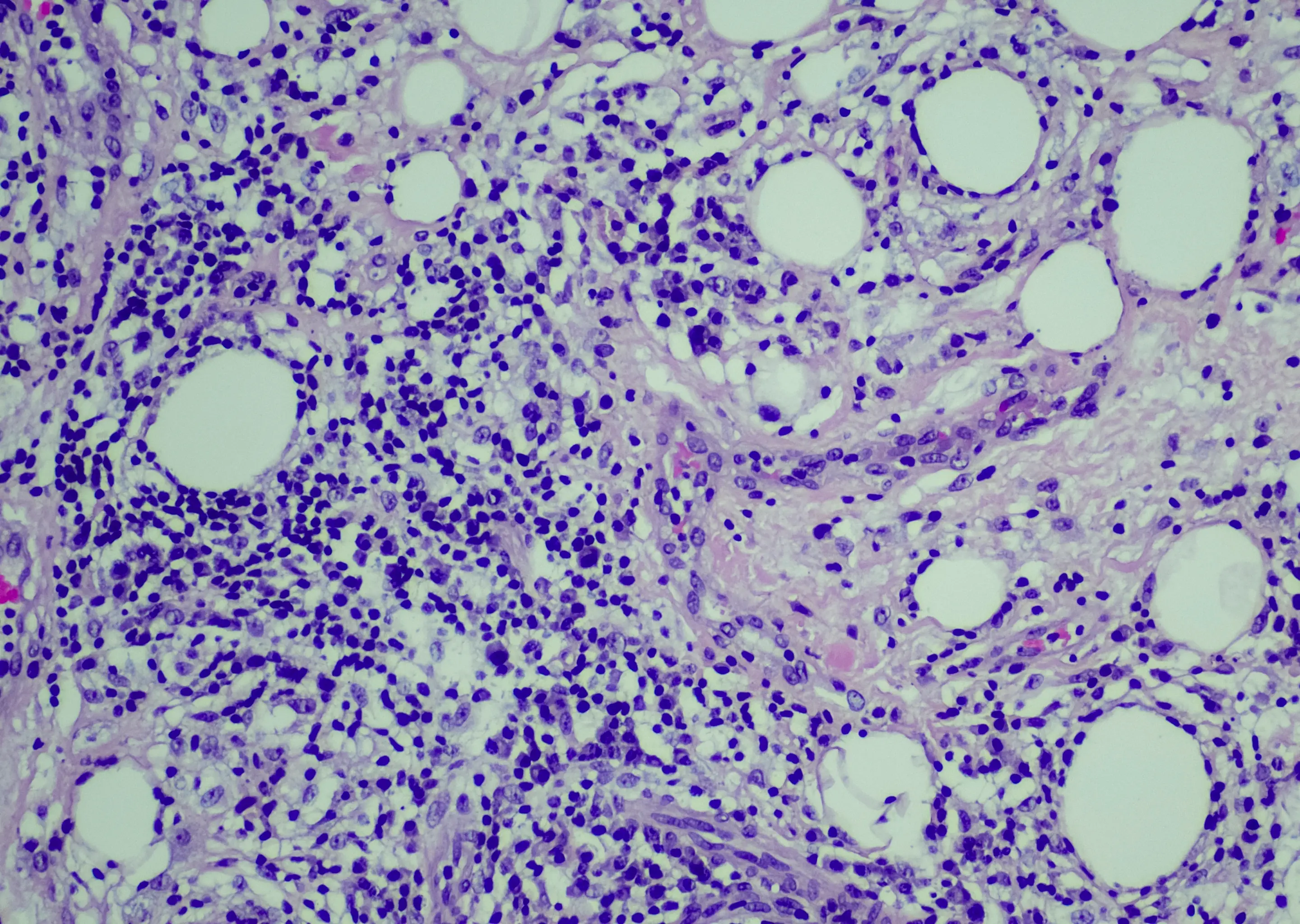 Lymphoma comes in two forms (Getty Stock Images)